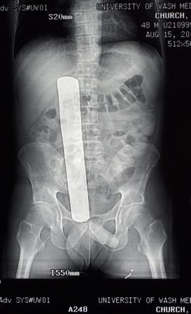 13-inch long, two-inch wide surgical retractor that was accidentally 
left in the body of Donald Church